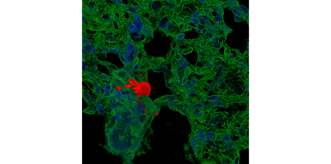 A Metastatic Breast Cancer Cell Exits the Lung Vasculature